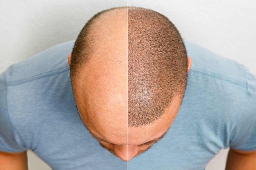 Crown view of a scalp after hair transplantation: left side before, right side after