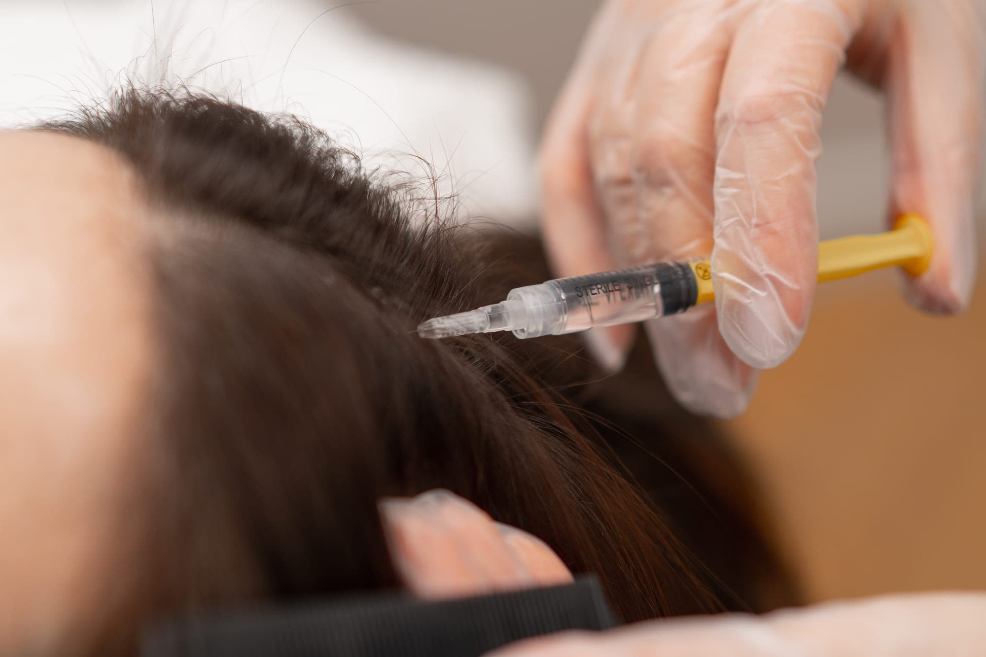 PRP treatment at Renewa Clinic