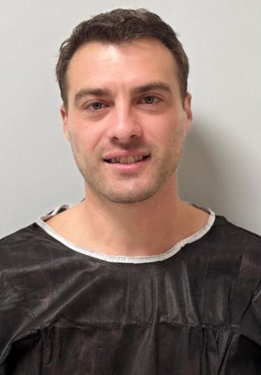 After hair transplantation, frontal view