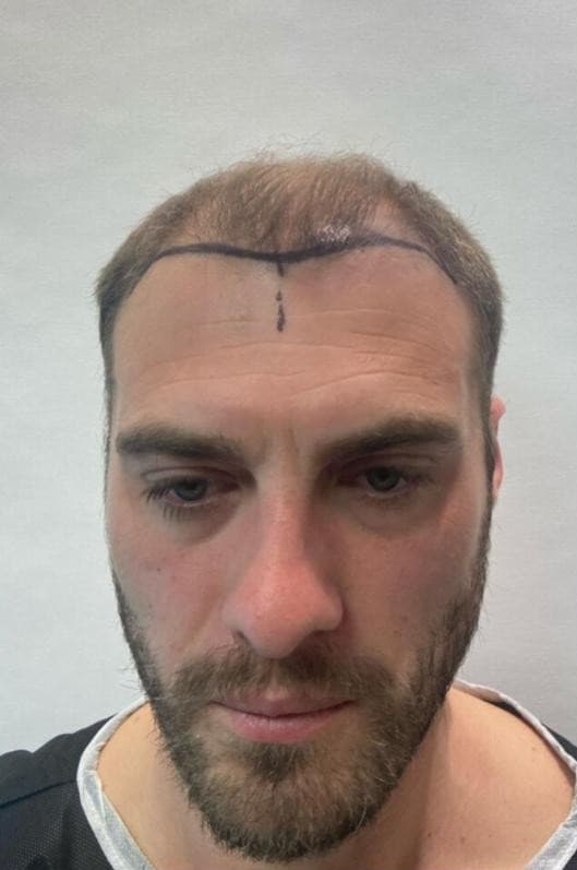 Before hair transplantation, frontal view
