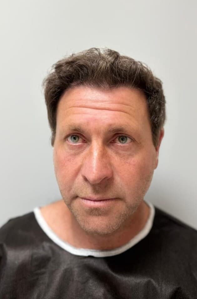 After hair transplantation, frontal view