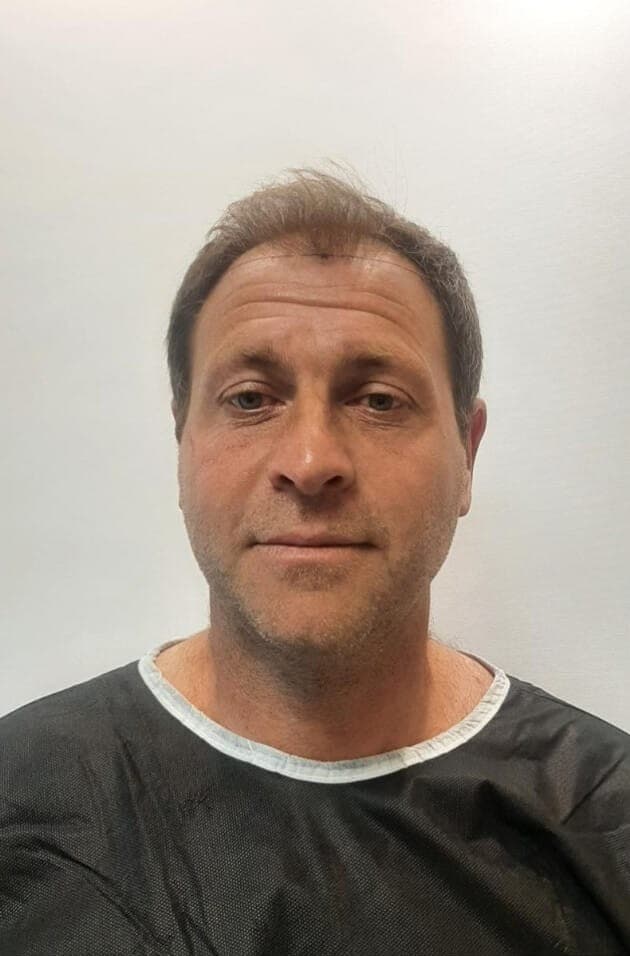 Before hair transplantation, frontal view