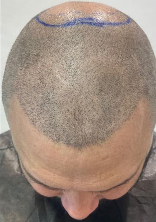 After hair transplantation, top-down view