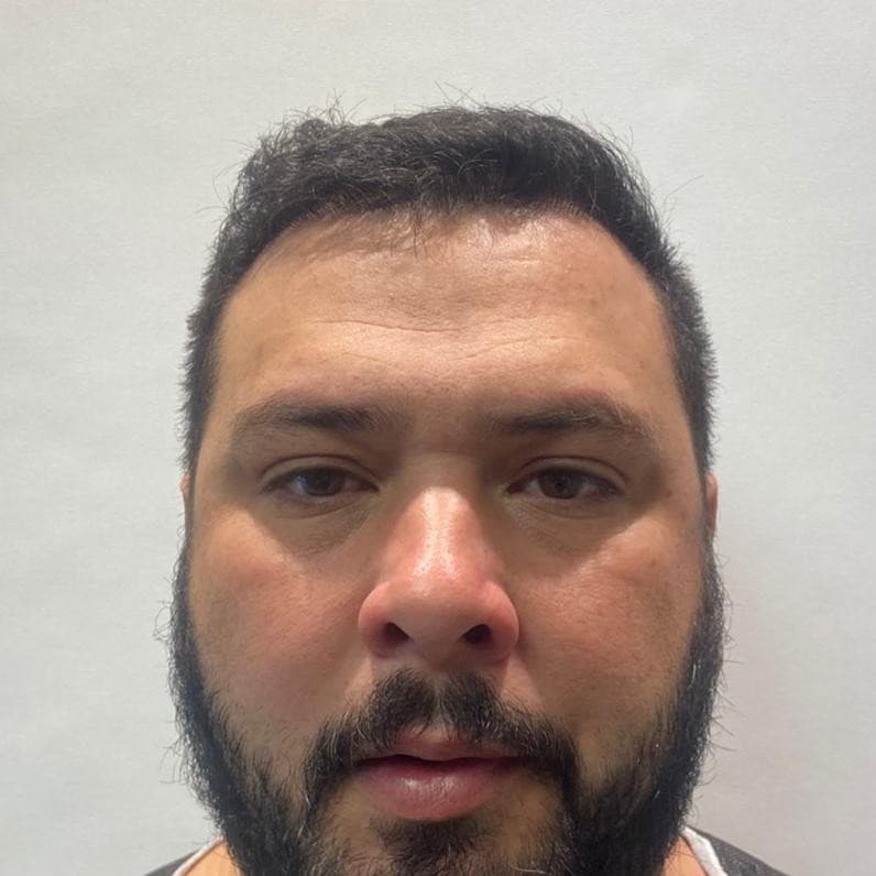 Before hair transplantation, frontal view