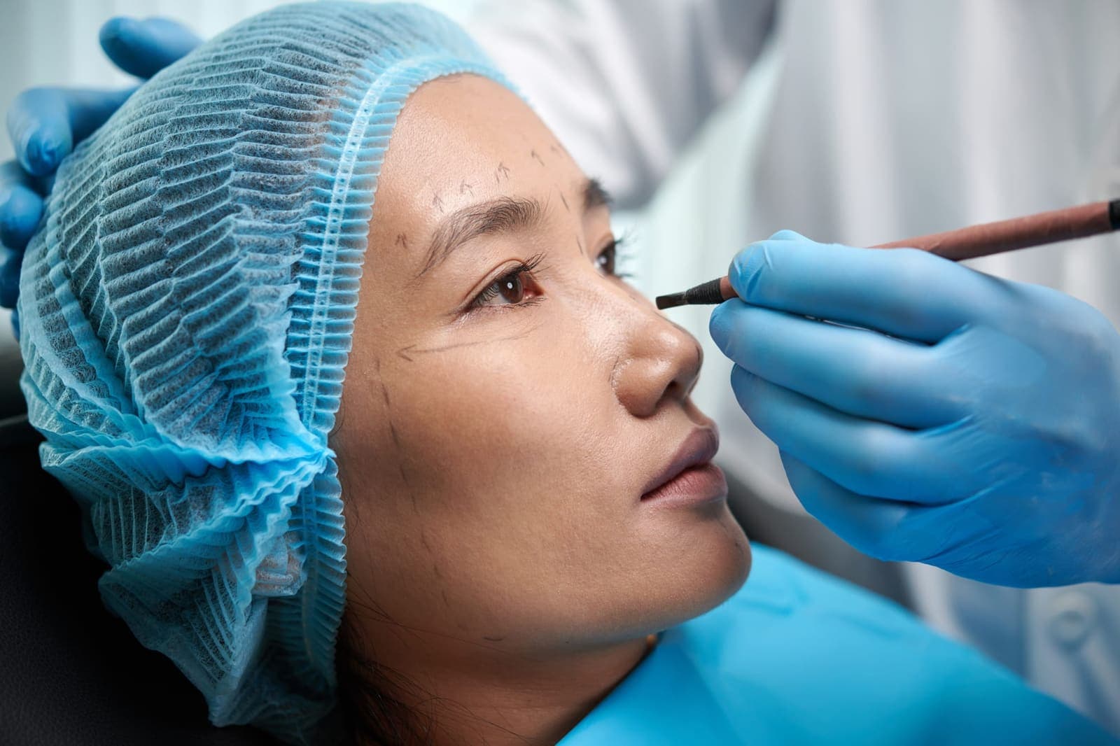 Bichectomy at Renewa Clinic