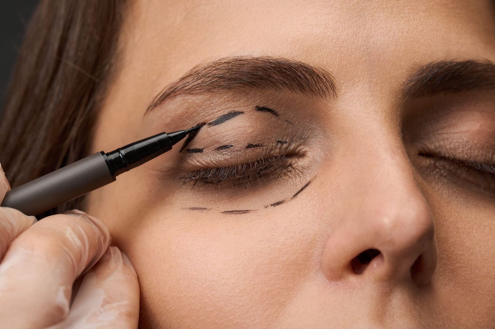 Blepharoplasty at Renewa Clinic
