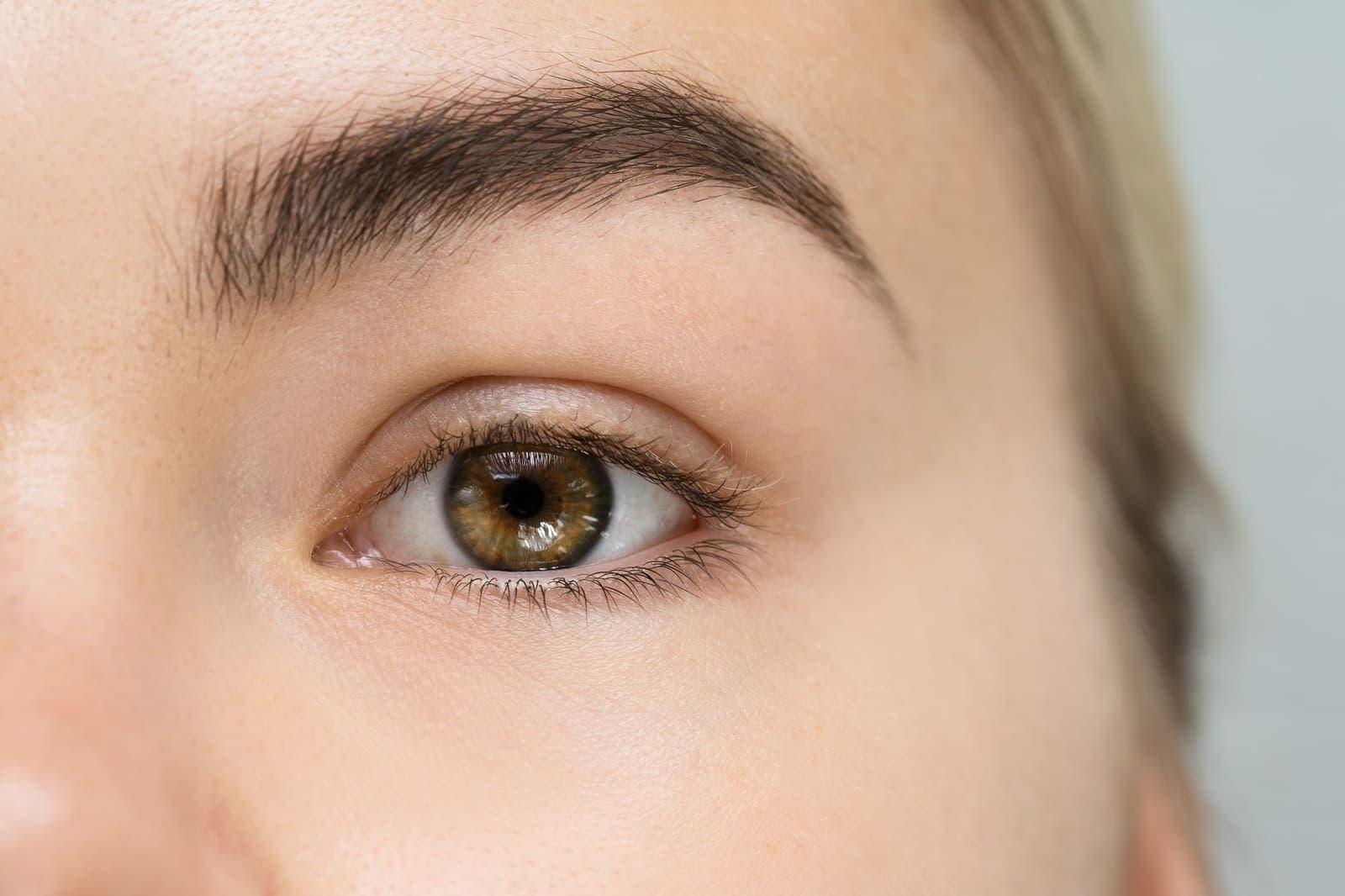 Eyebrow transplantation at Renewa Clinic