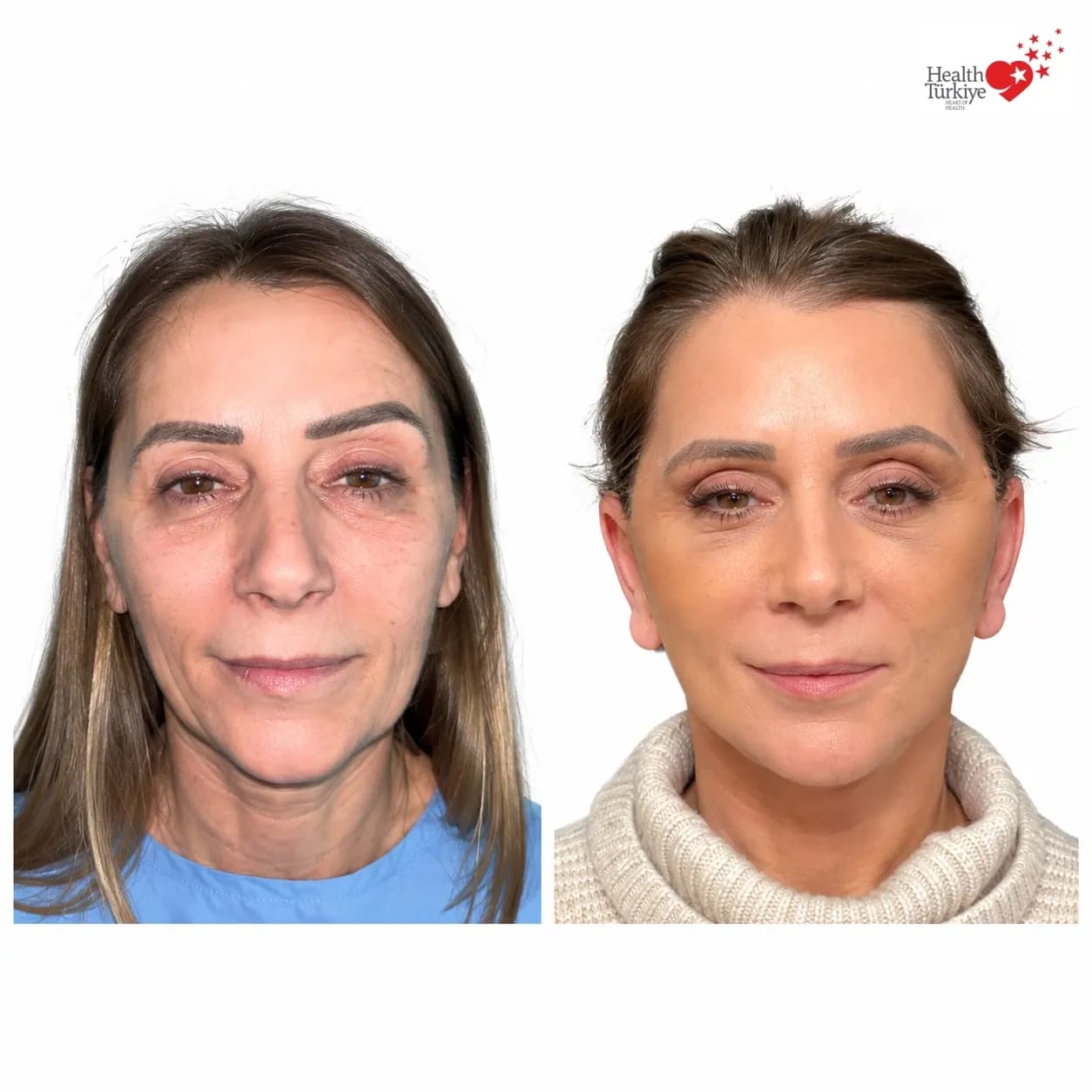 Before and after face and neck lift