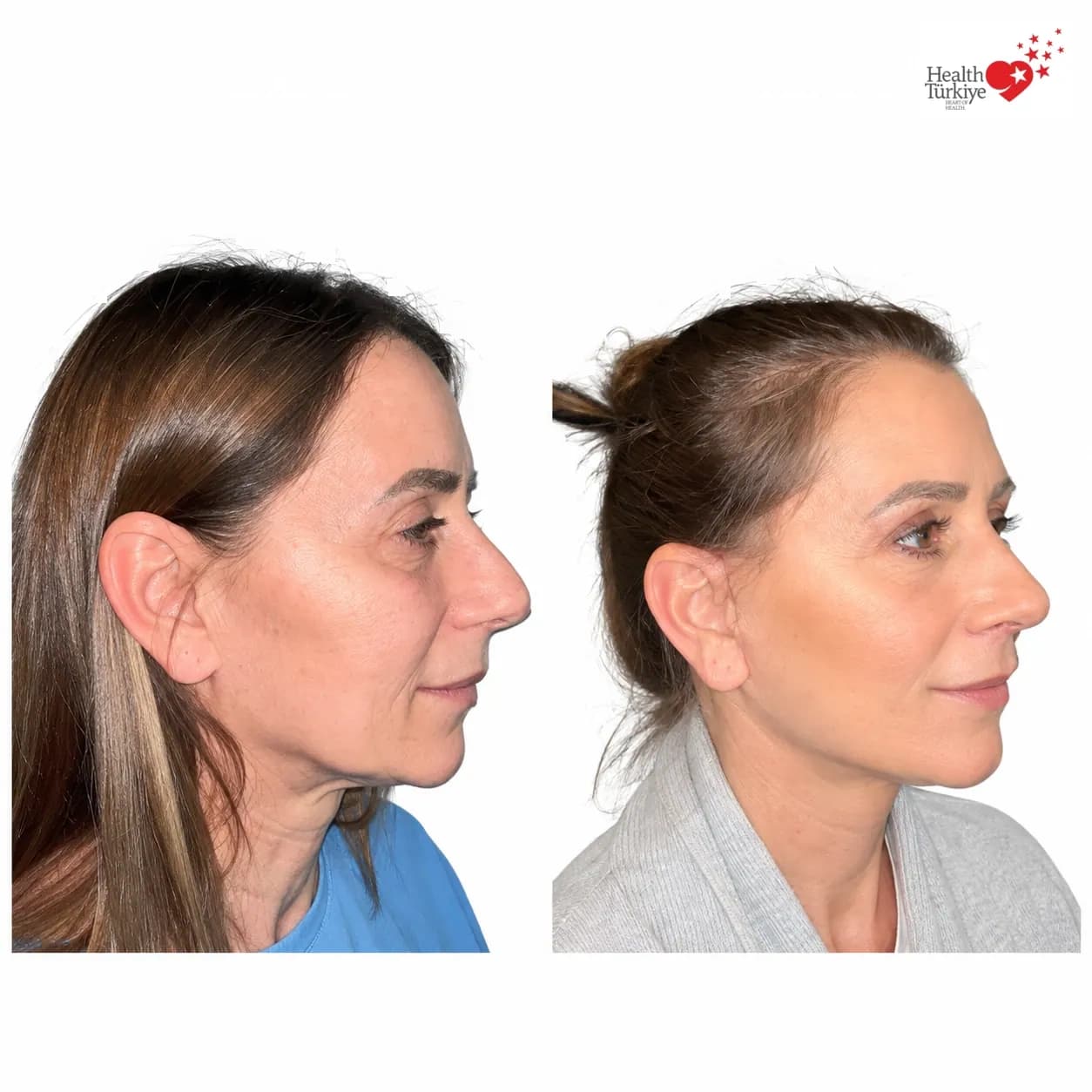 Before and after face and neck lift