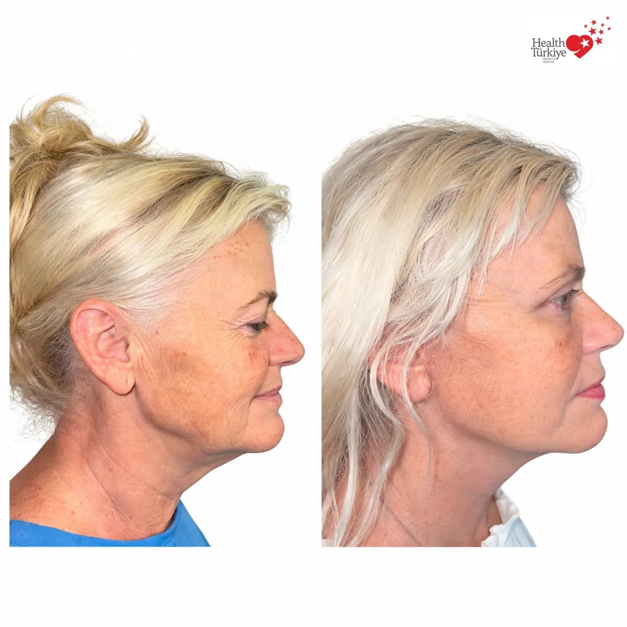 Before and after face and neck lift