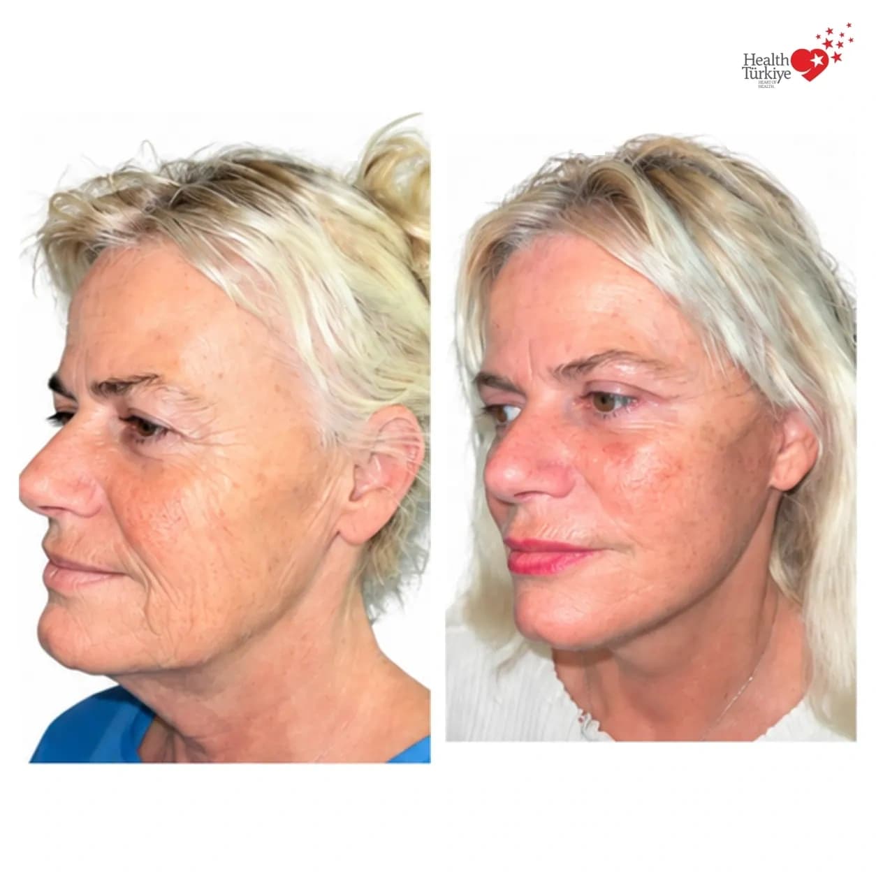 Before and after face and neck lift