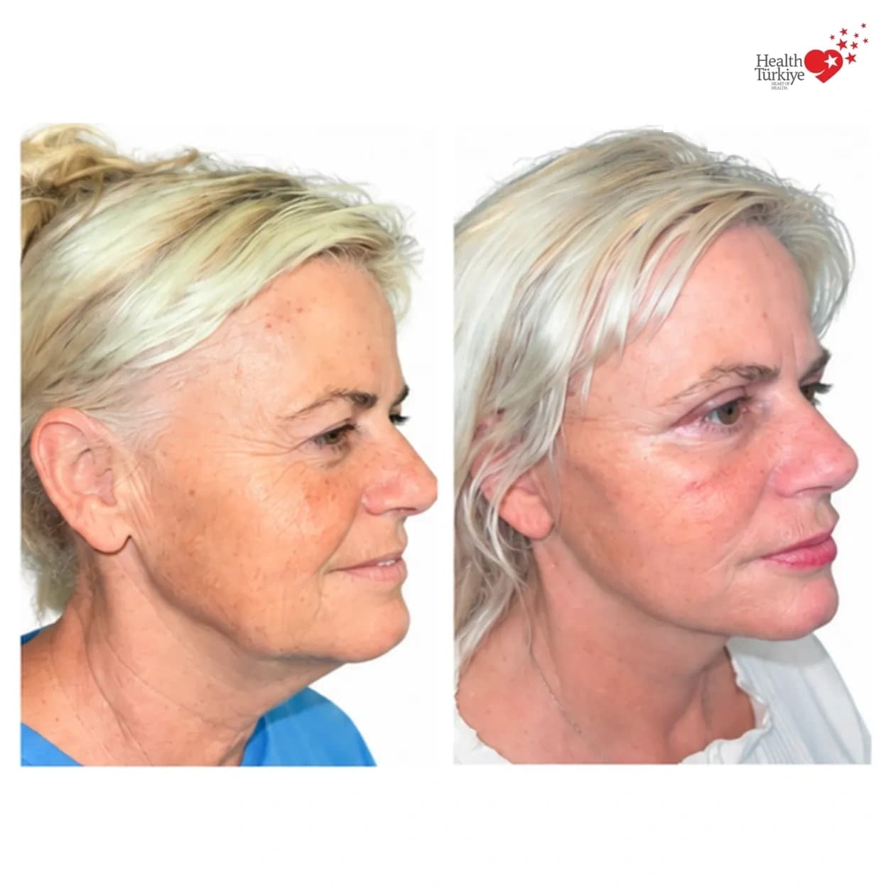 Before and after face and neck lift