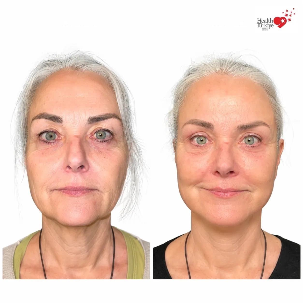 Before and after face and neck lift