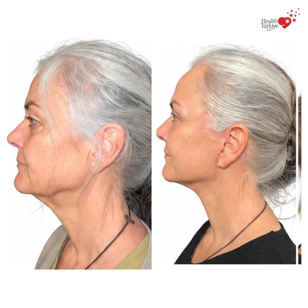 Before and after face and neck lift