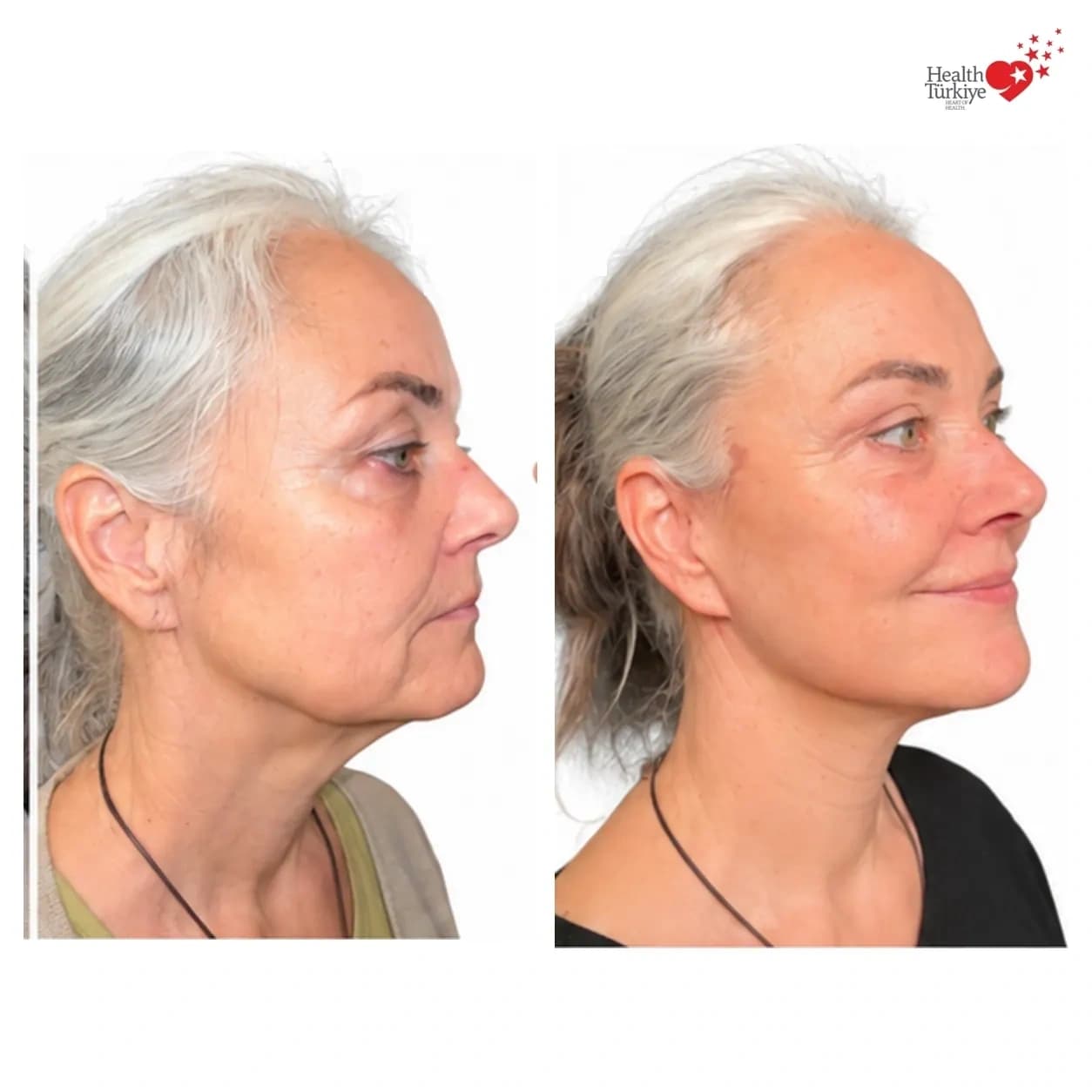 Before and after face and neck lift