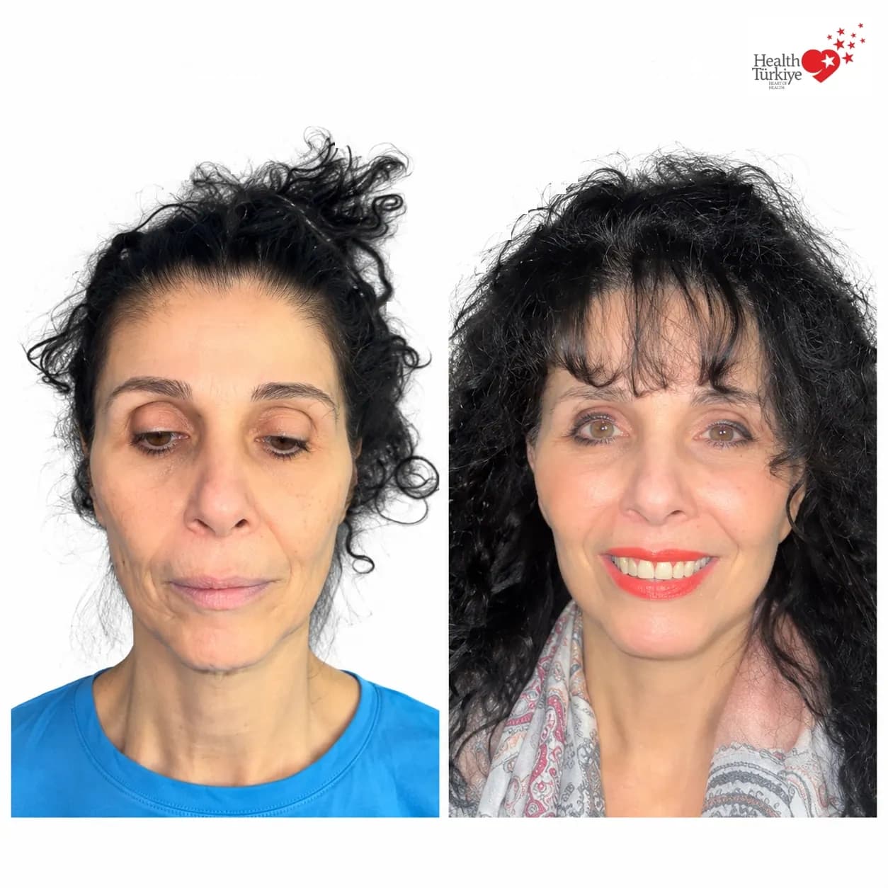 Before and after face and neck lift