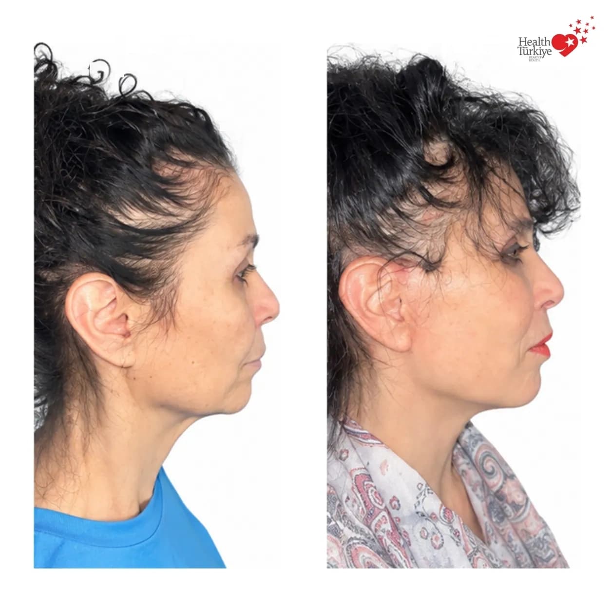 Before and after face and neck lift