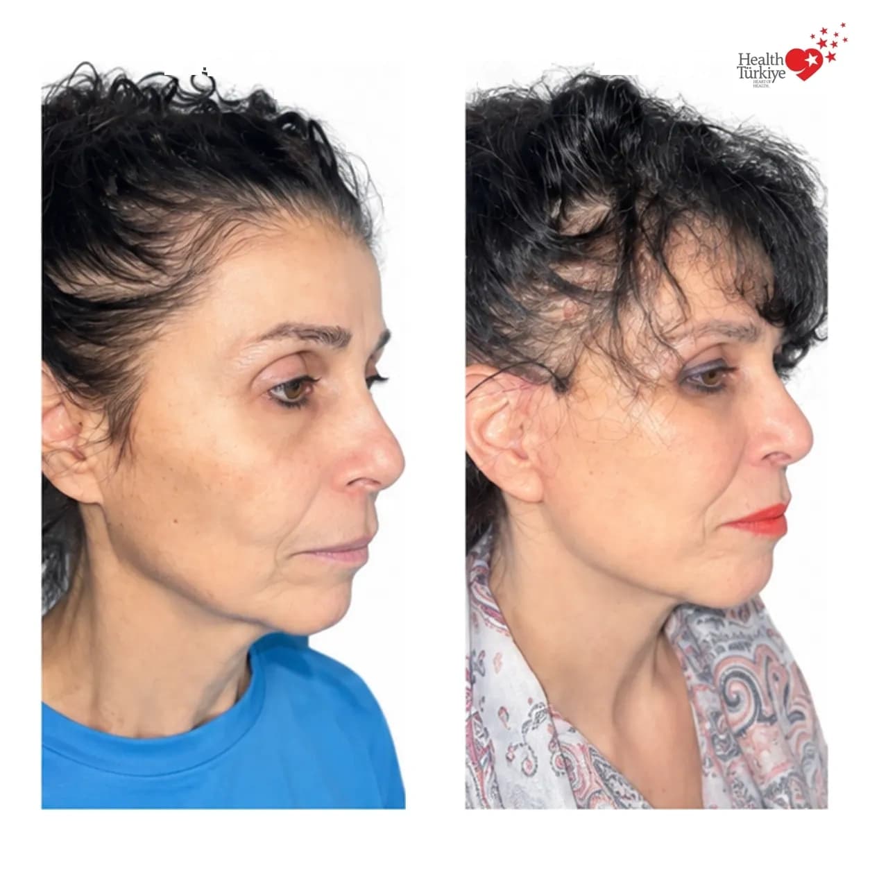 Before and after face and neck lift