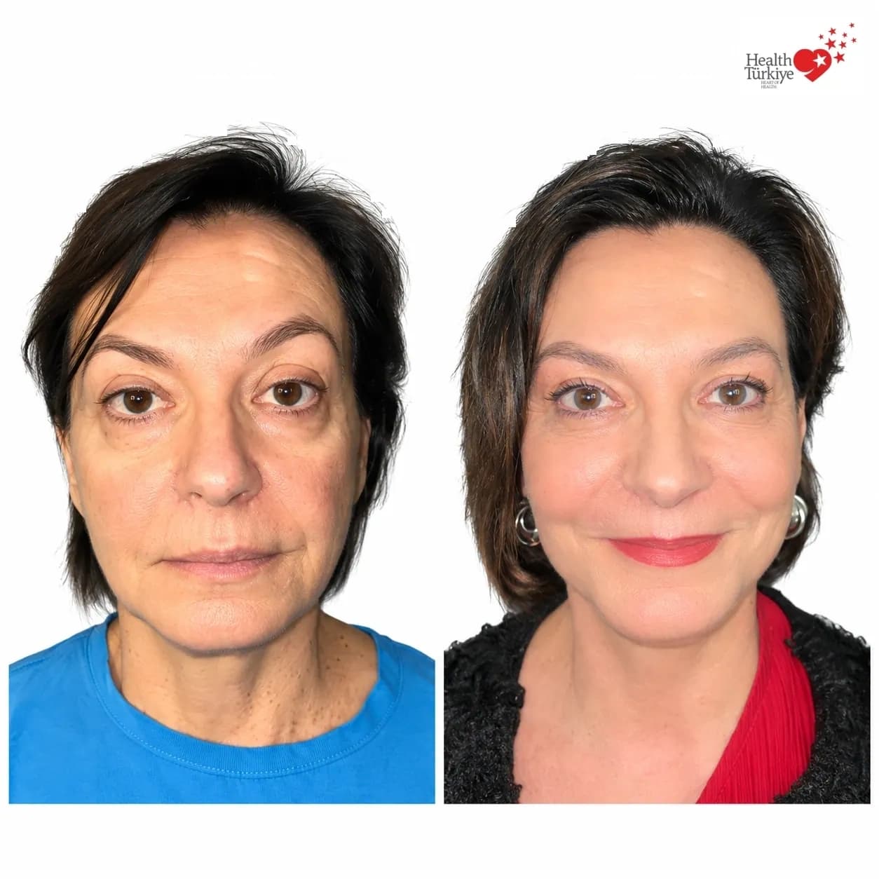 Before and after face and neck lift