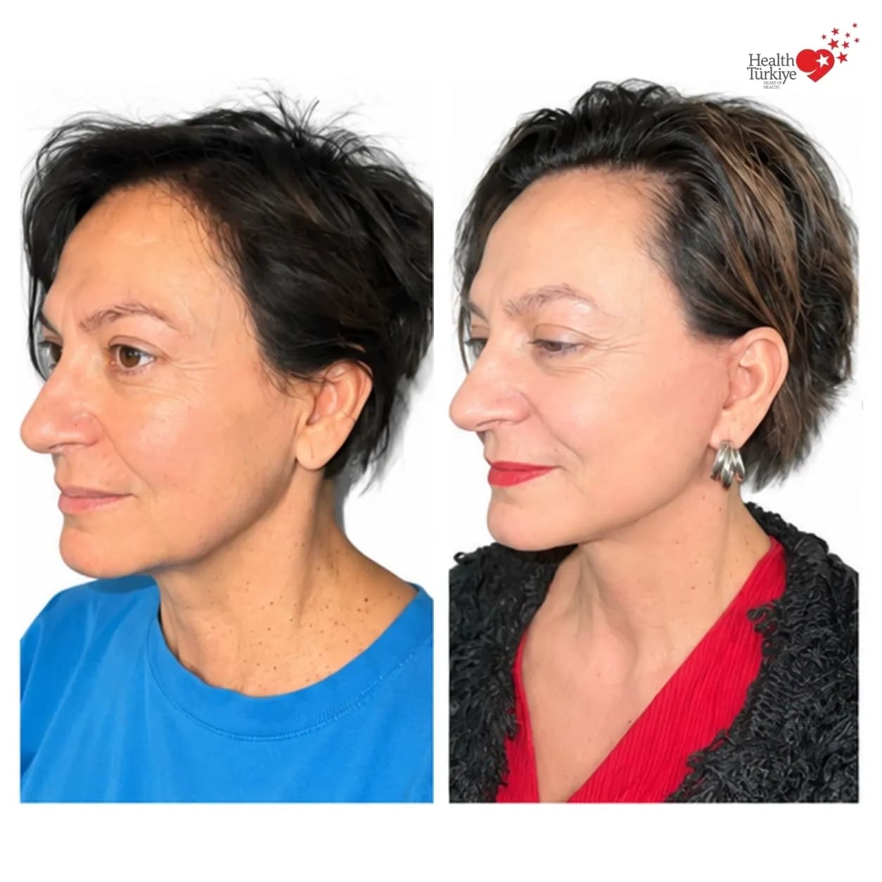 Before and after face and neck lift