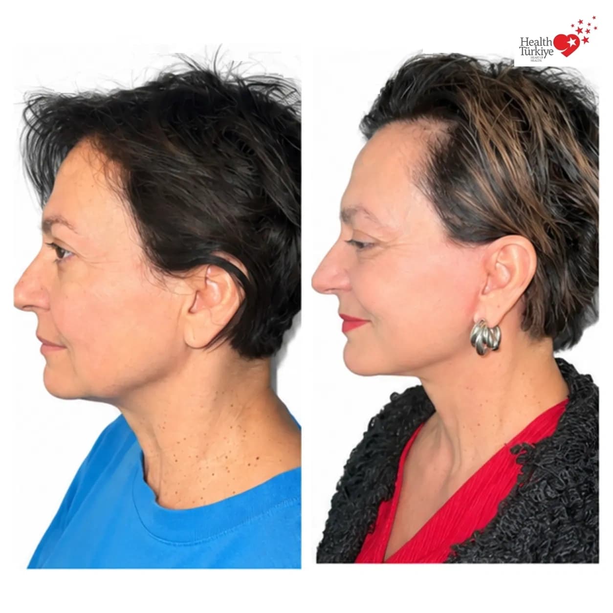 Before and after face and neck lift