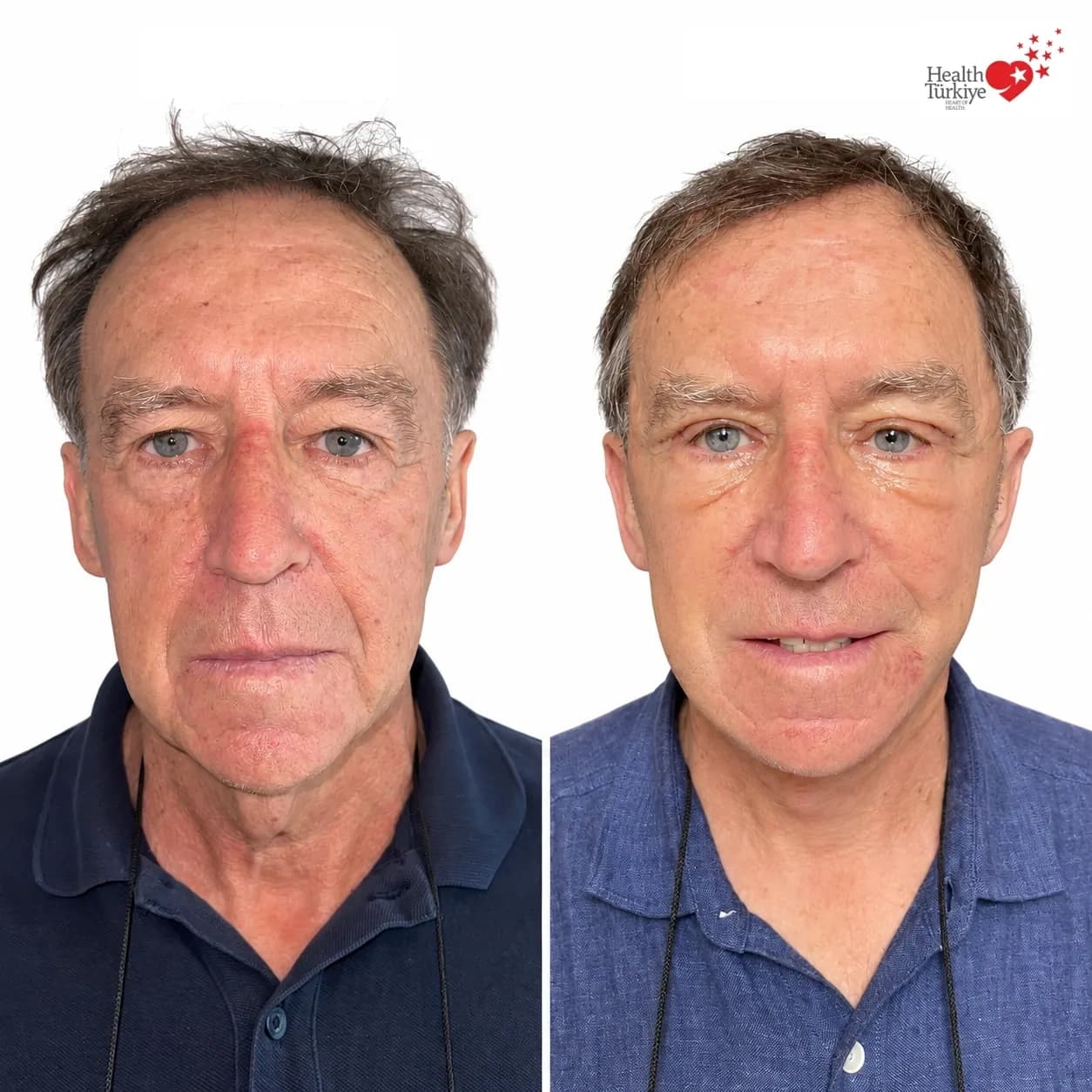 Before and after face and neck lift