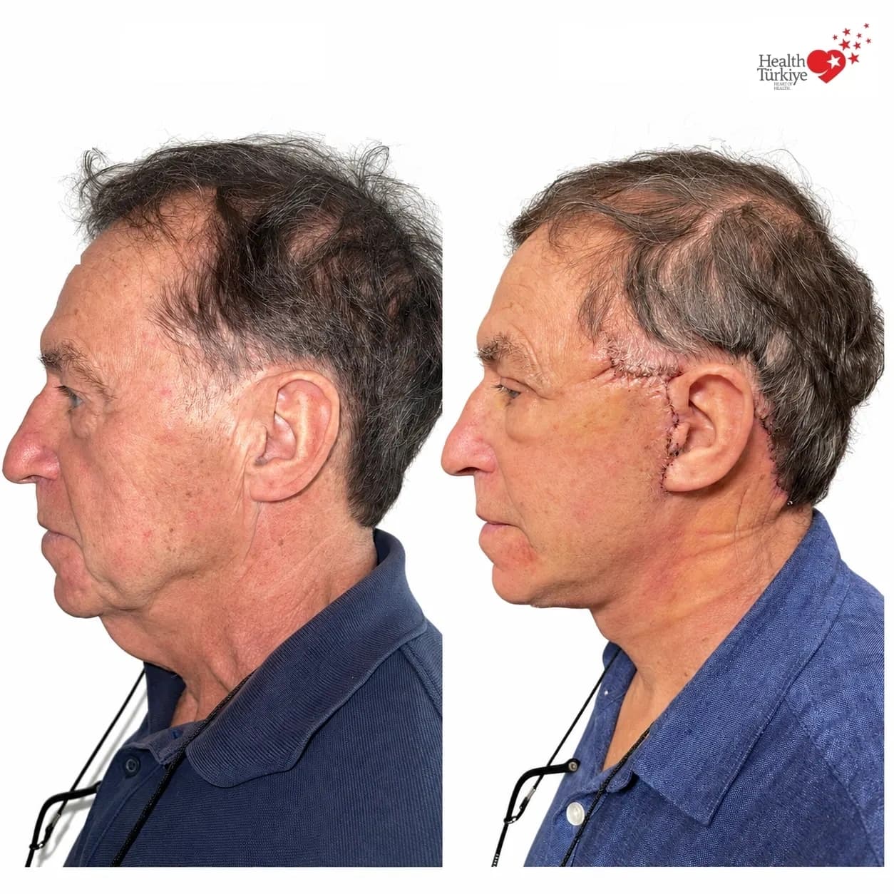 Before and after face and neck lift