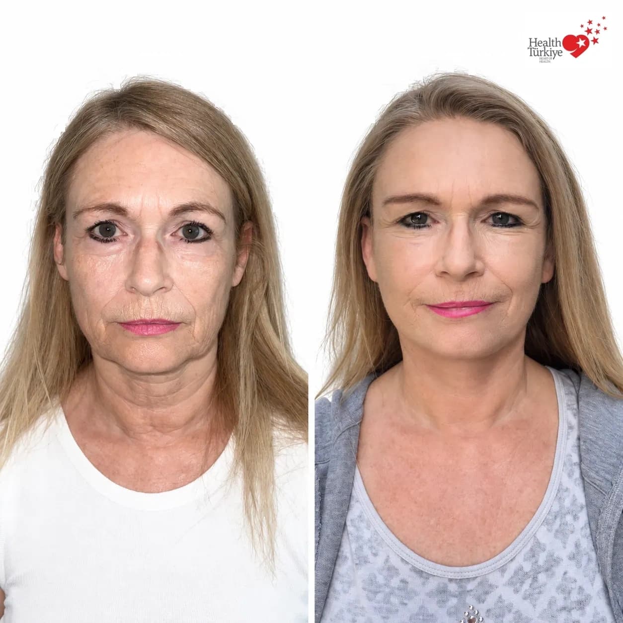 Before and after face and neck lift
