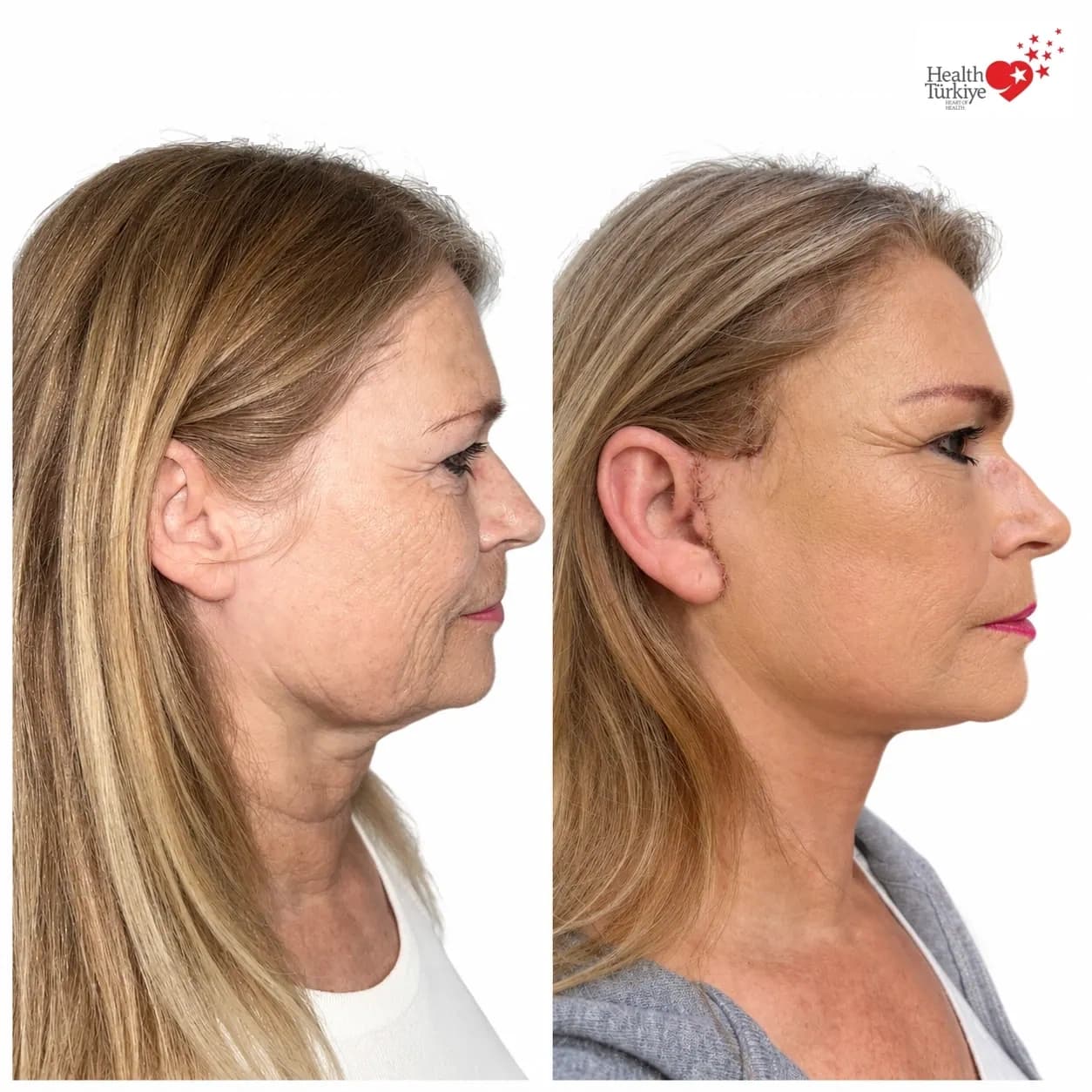 Before and after face and neck lift