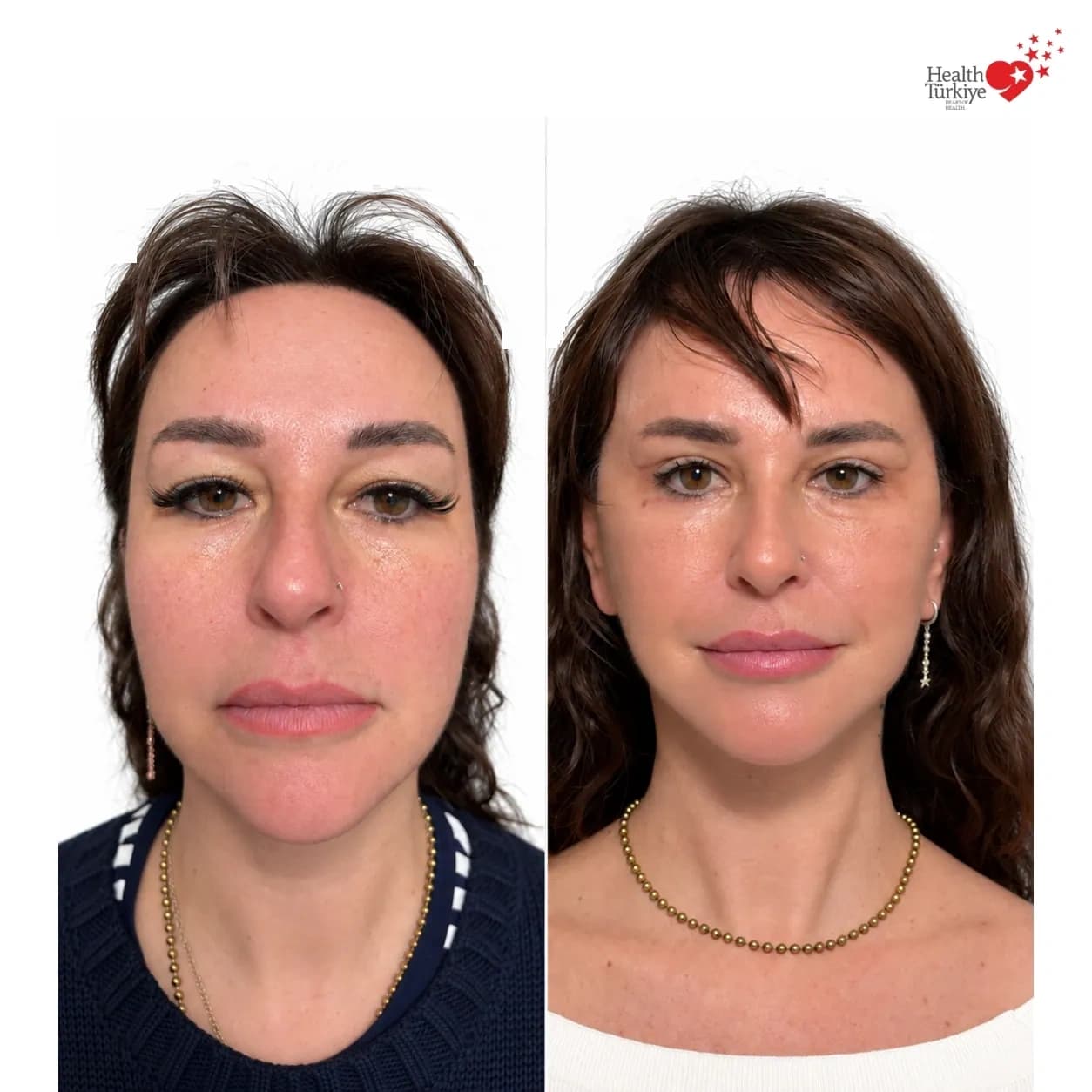 Before and after face and neck lift