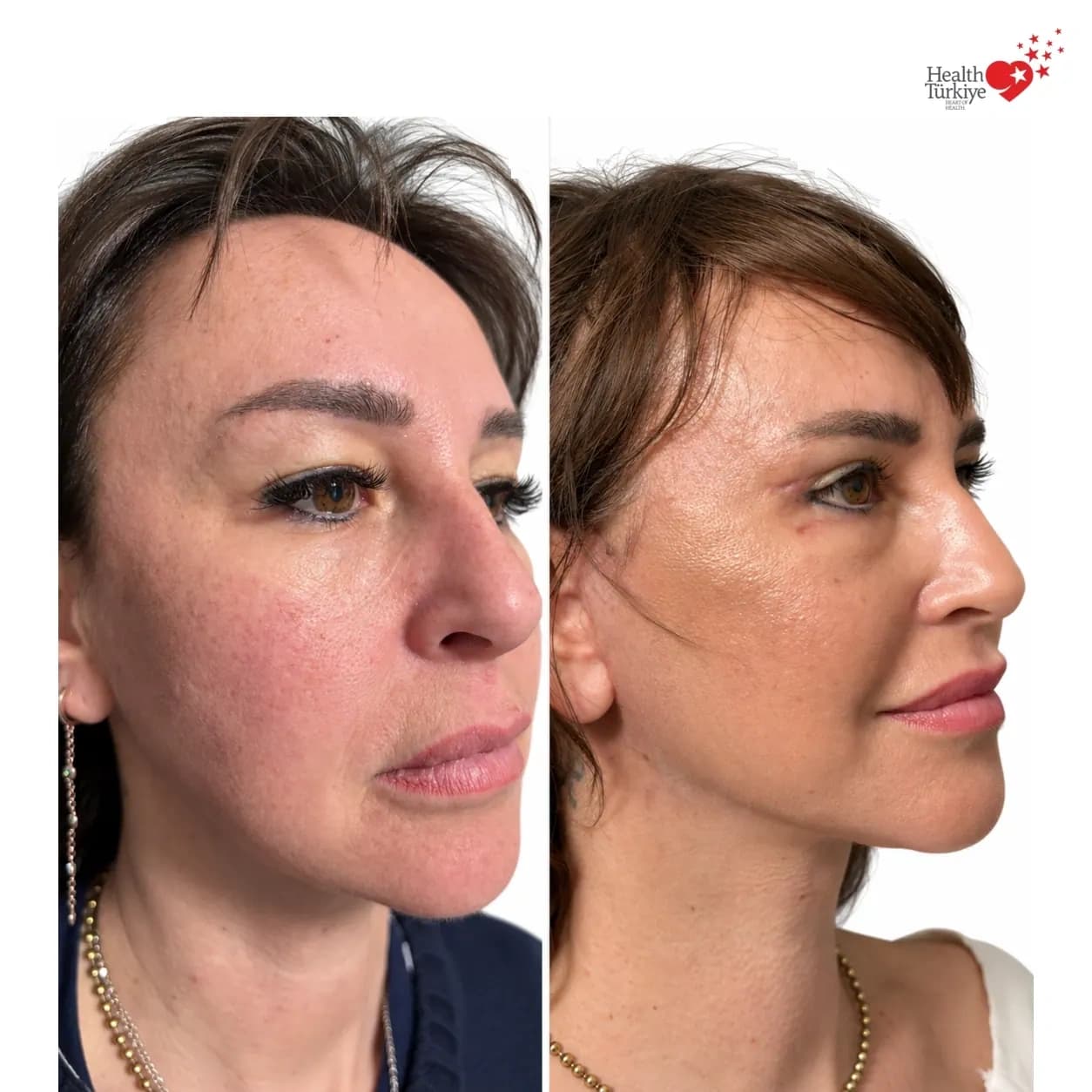 Before and after face and neck lift