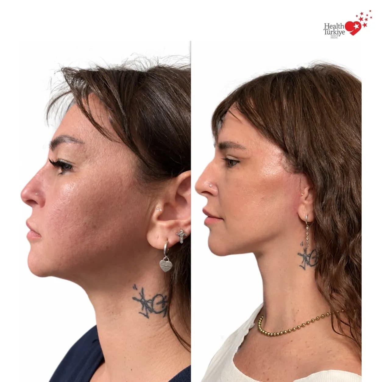 Before and after face and neck lift