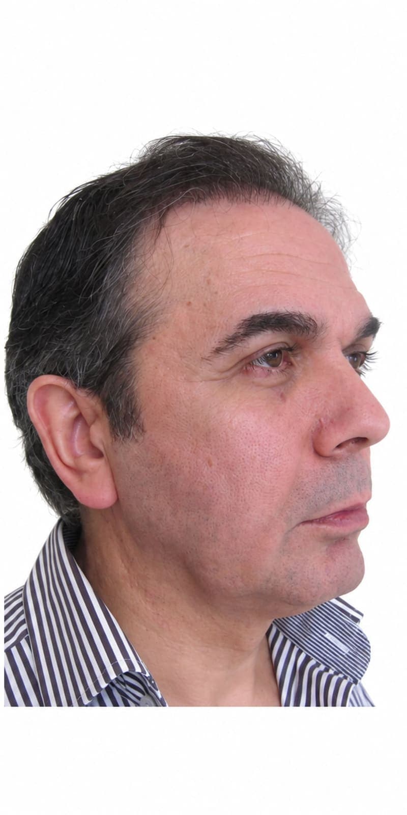 After face and neck lift