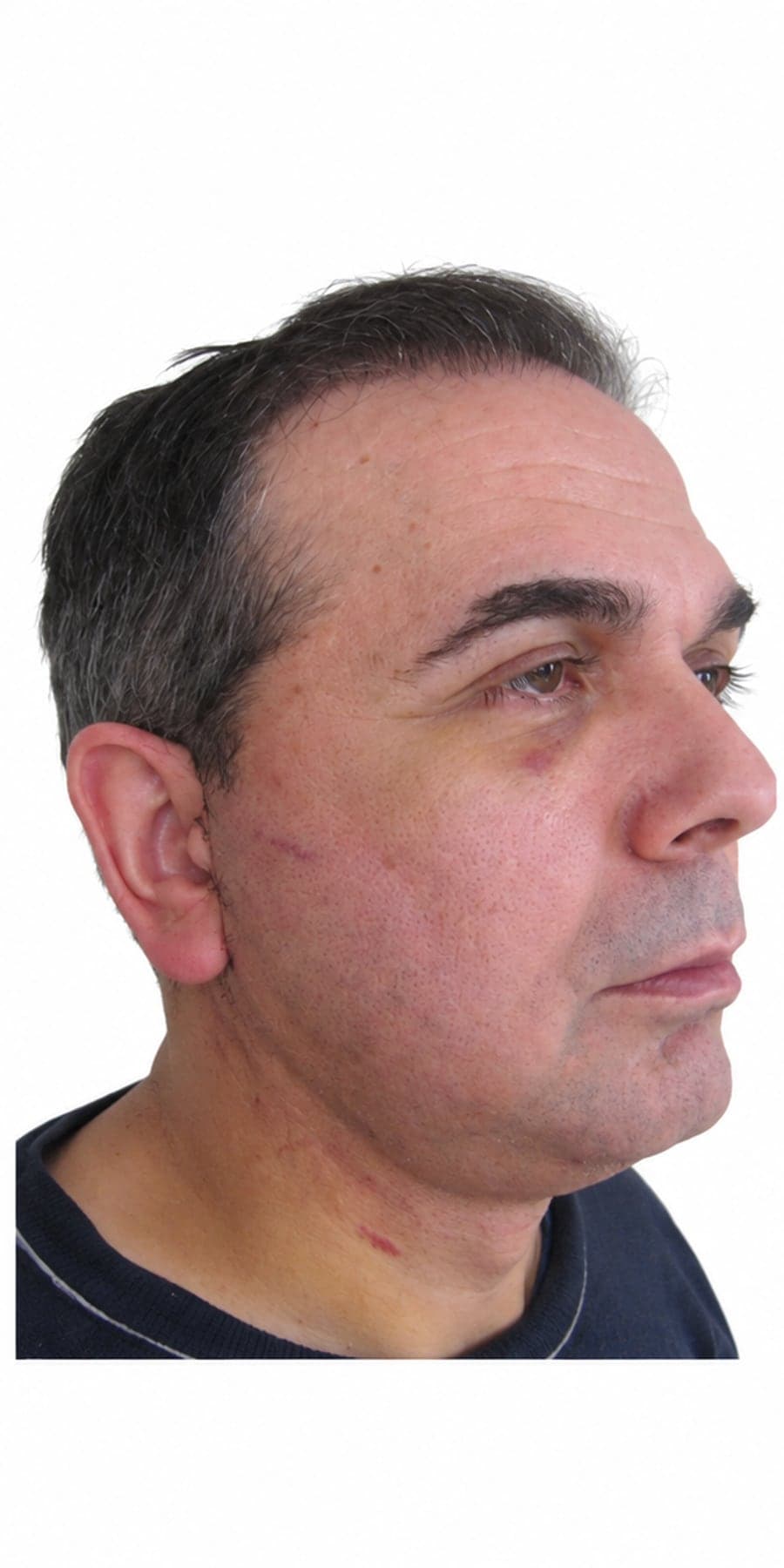 Before face and neck lift
