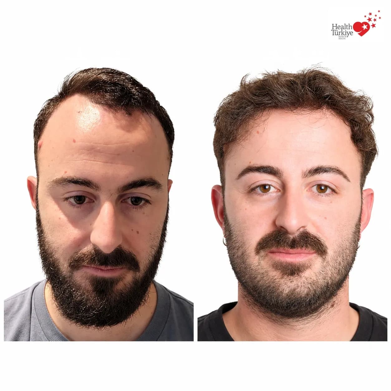 Before and after hair transplantation