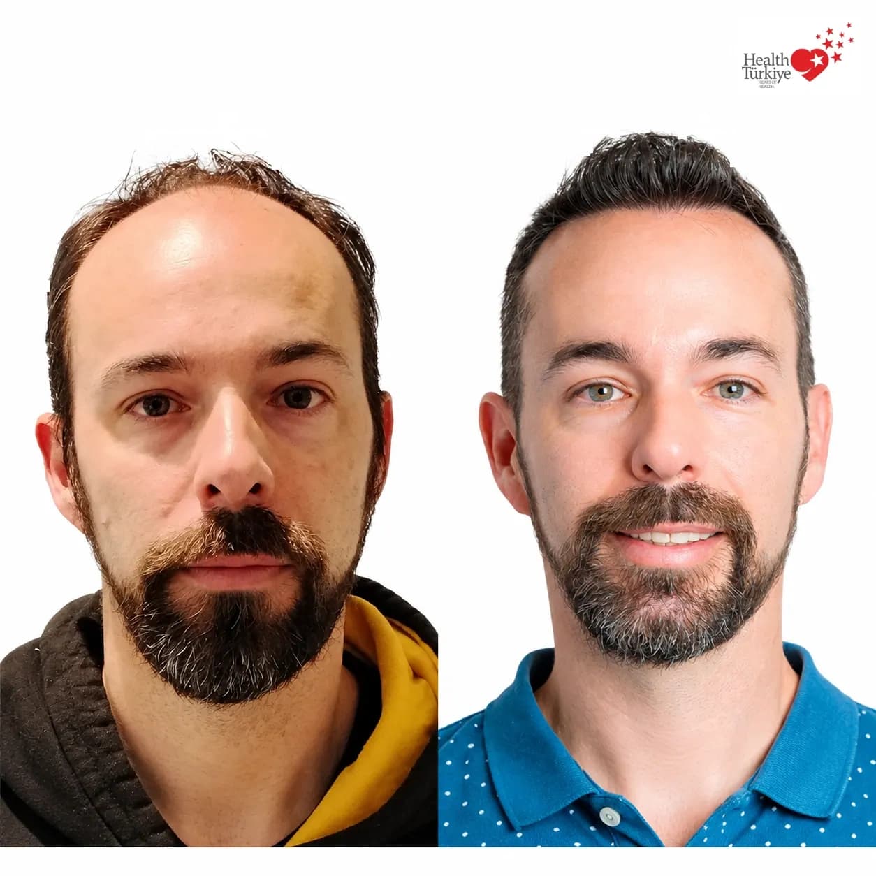 Before and after hair transplantation