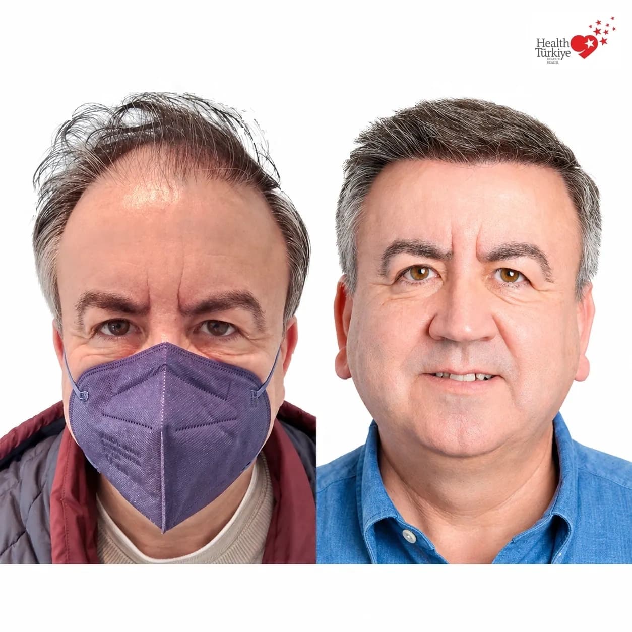 Before and after hair transplantation