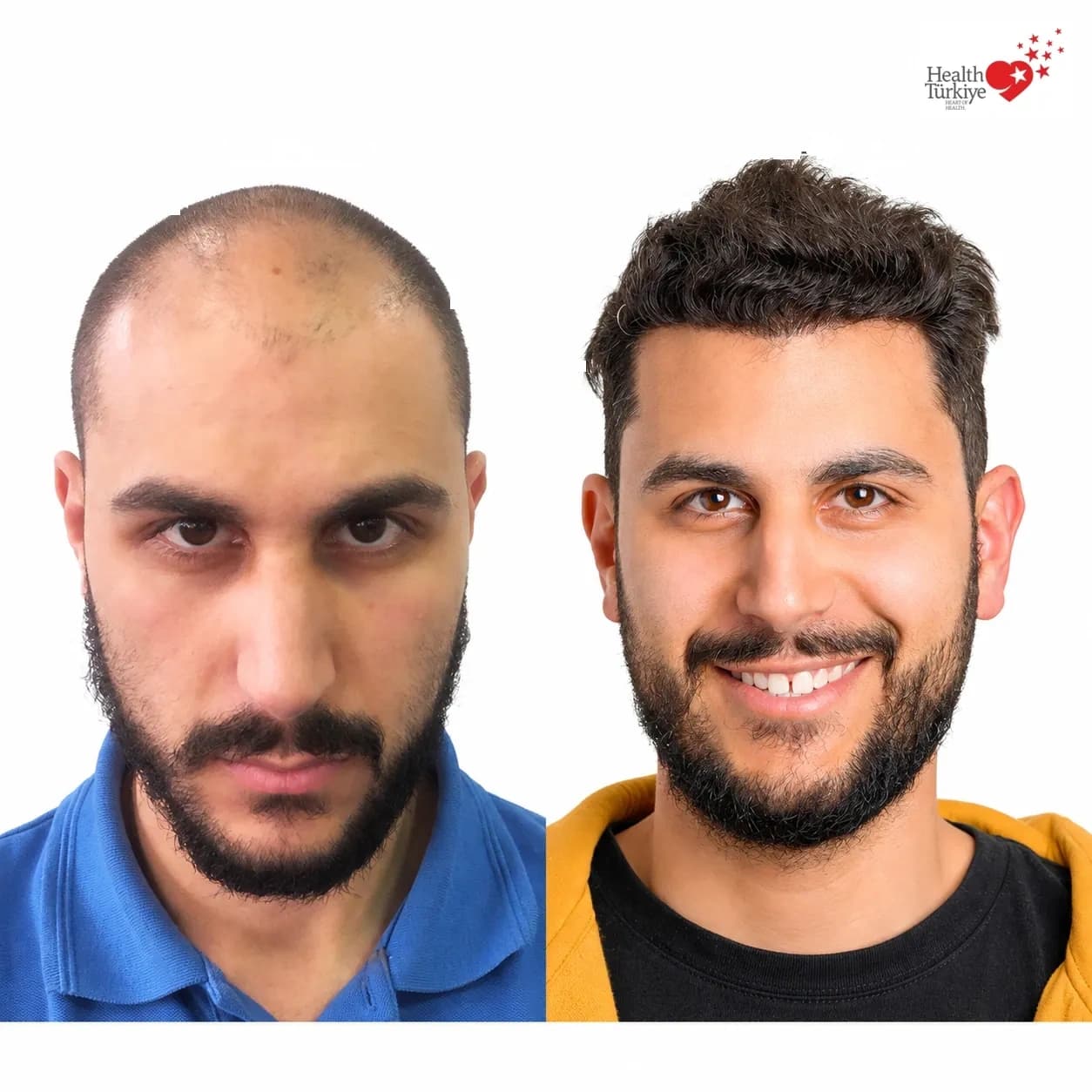 Before and after hair transplantation