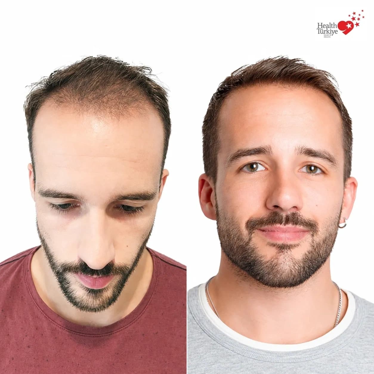 Before and after hair transplantation