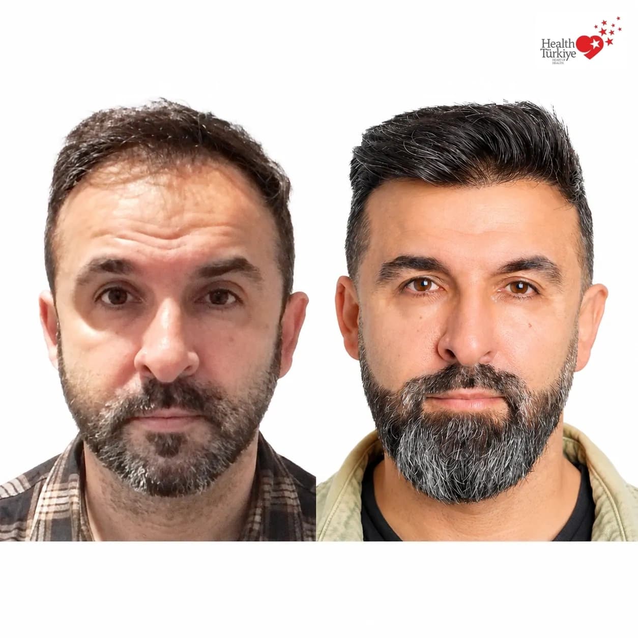 Before and after hair transplantation
