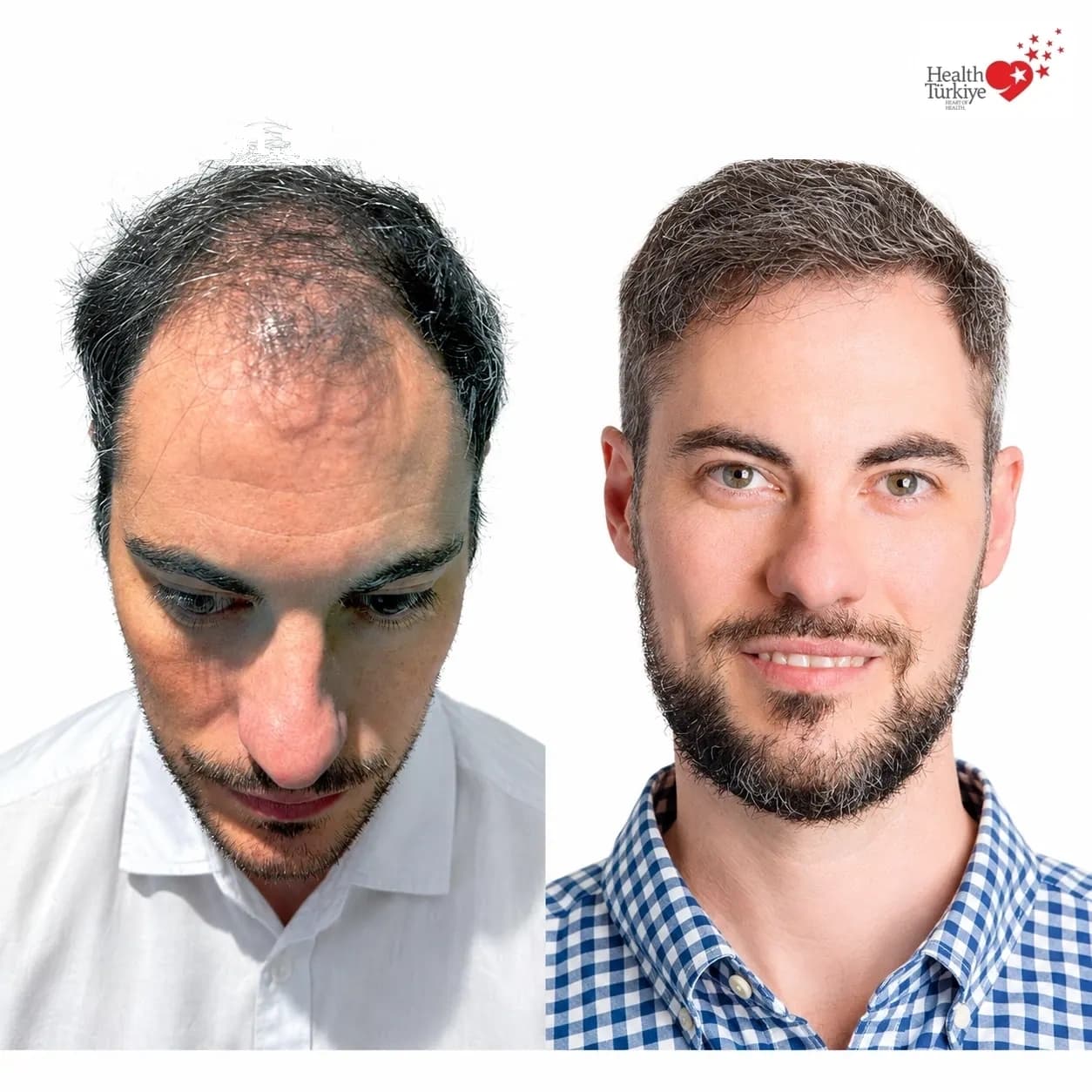 Before and after hair transplantation