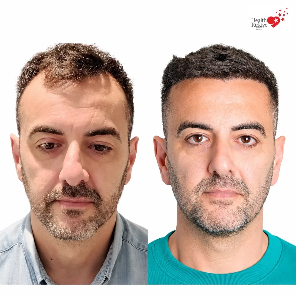 Before and after hair transplantation