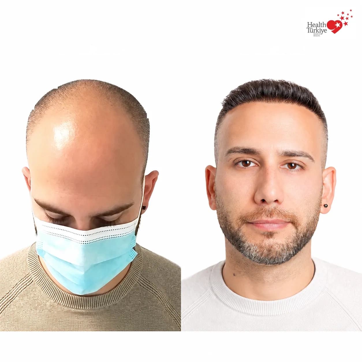 Before and after hair transplantation