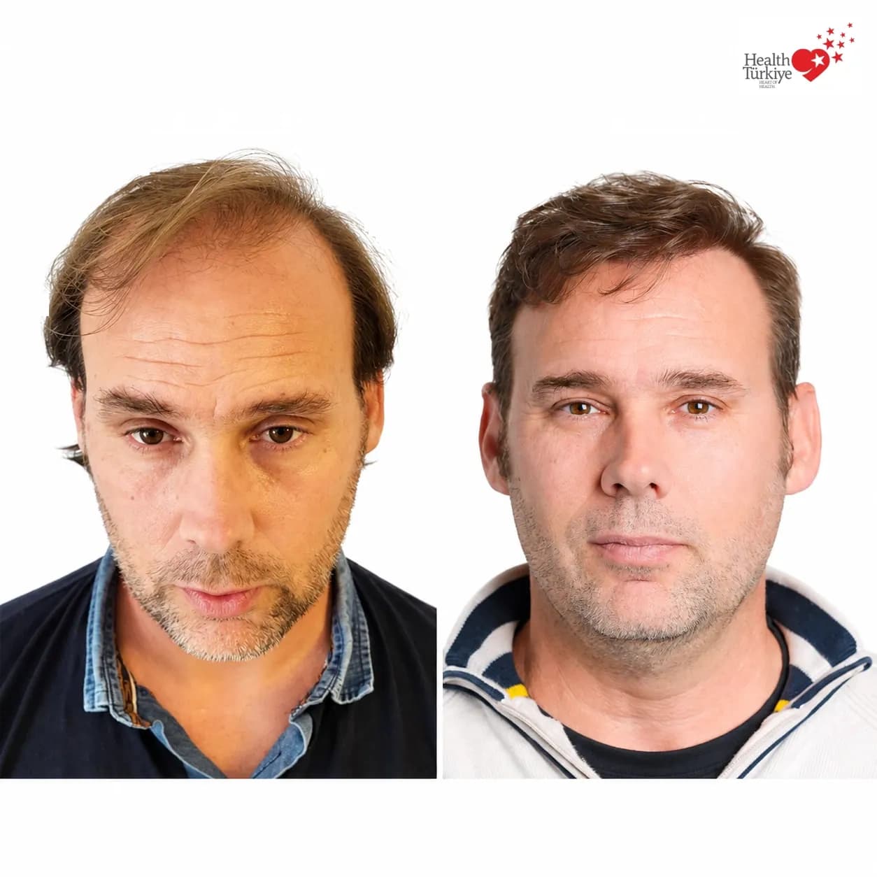 Before and after hair transplantation