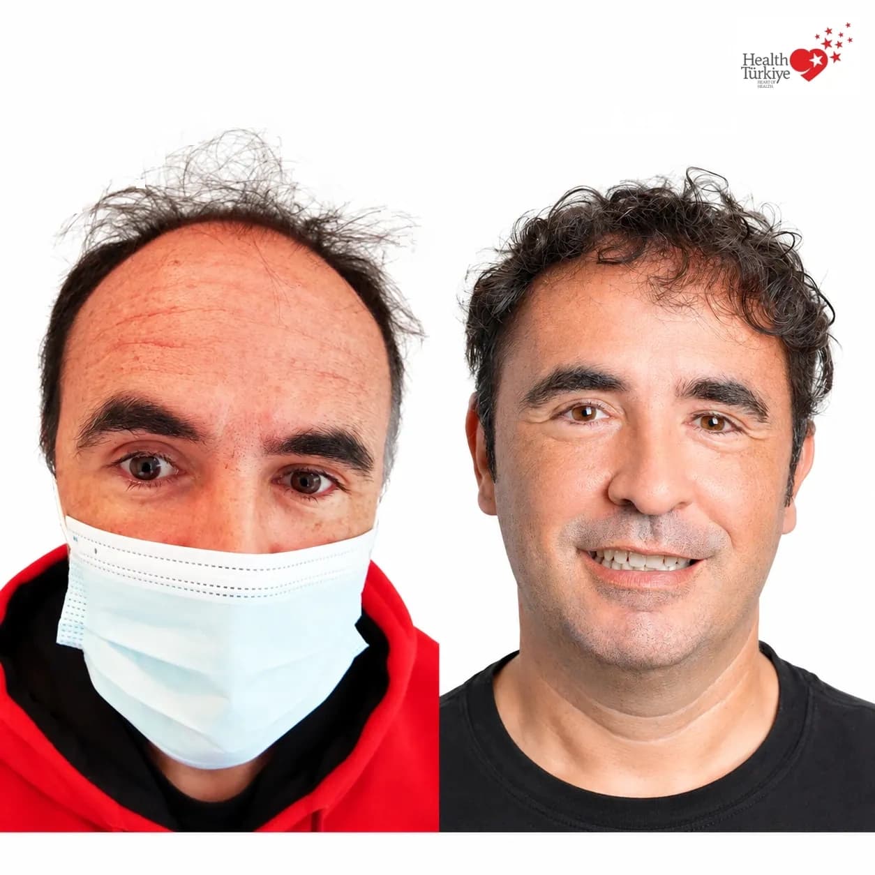 Before and after hair transplantation