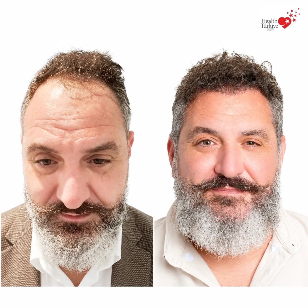 Before and after hair transplantation