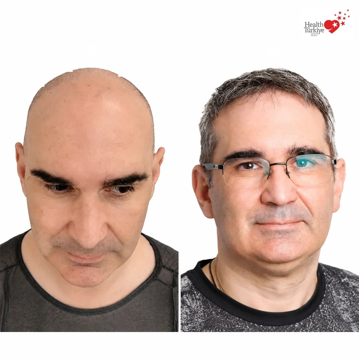 Before and after hair transplantation
