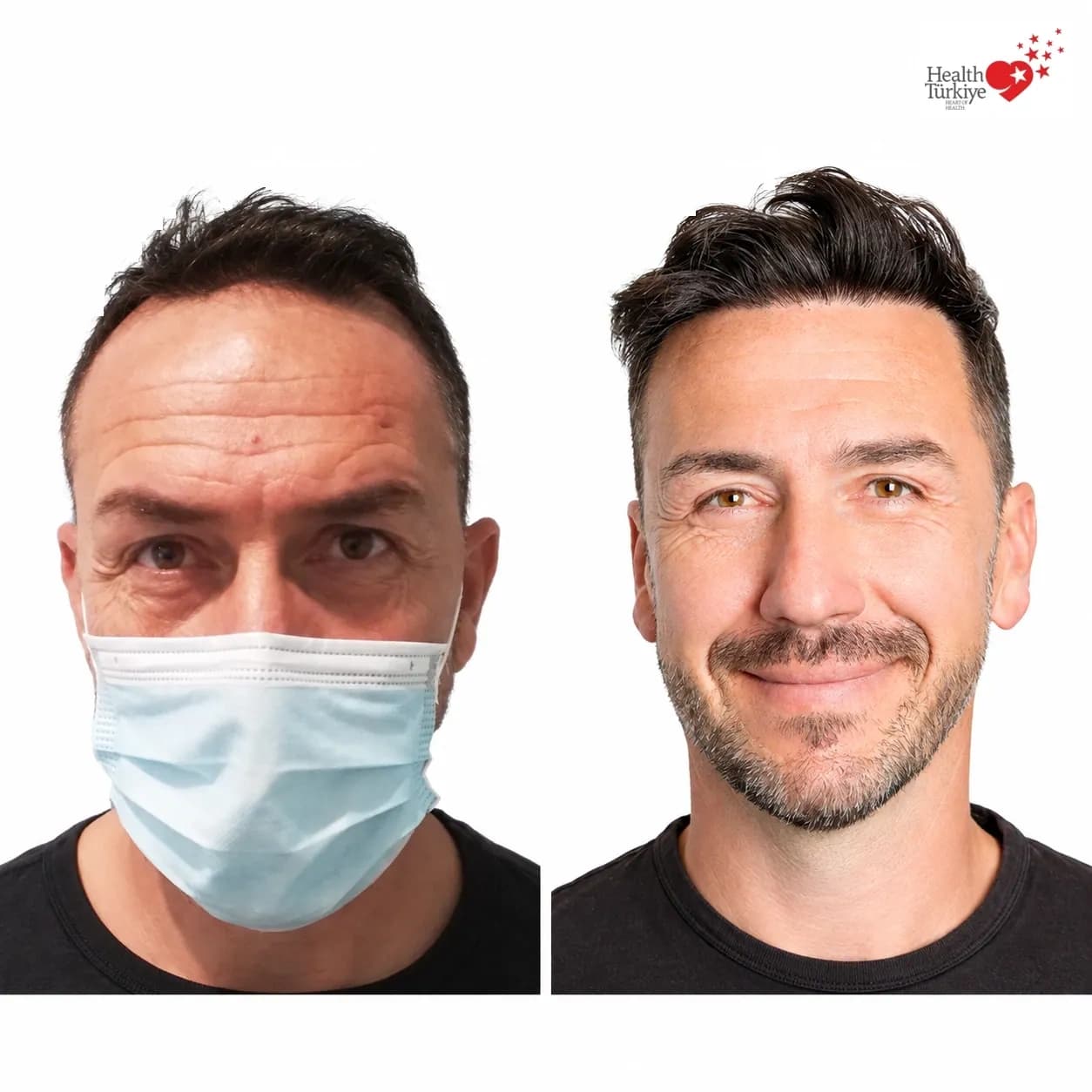 Before and after hair transplantation