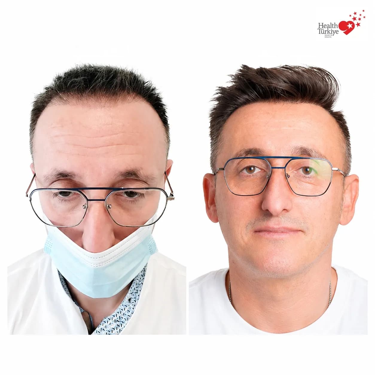 Before and after hair transplantation