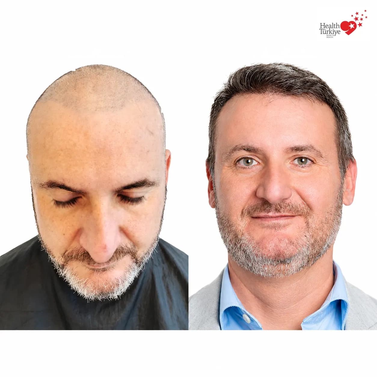 Before and after hair transplantation